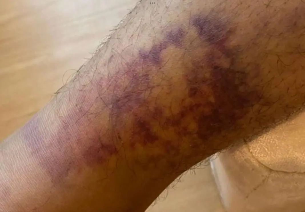 Indian Tourist ‘Beaten and Robbed’ in Pattaya Club Horror